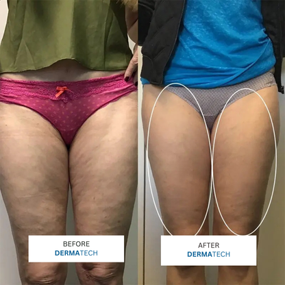 DERMATECH 3 in 1 Sculping Tech