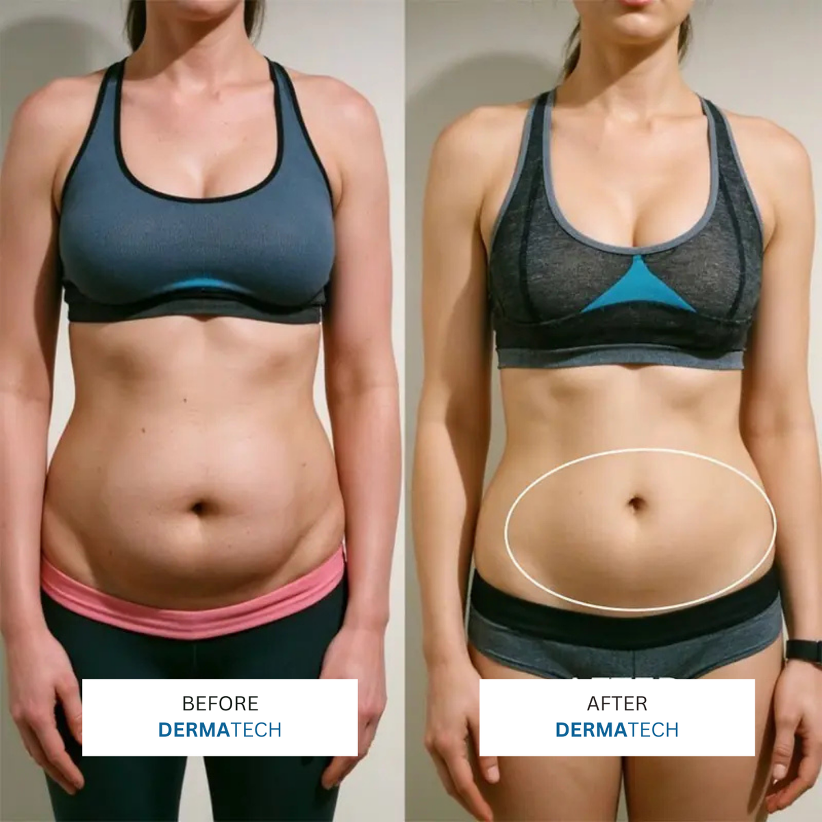 DERMATECH 3 in 1 Sculping Tech