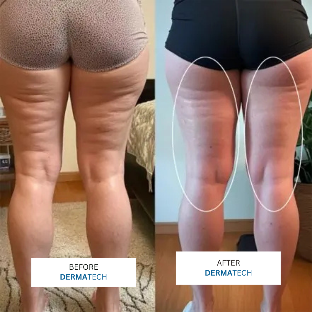 DERMATECH 3 in 1 Sculping Tech