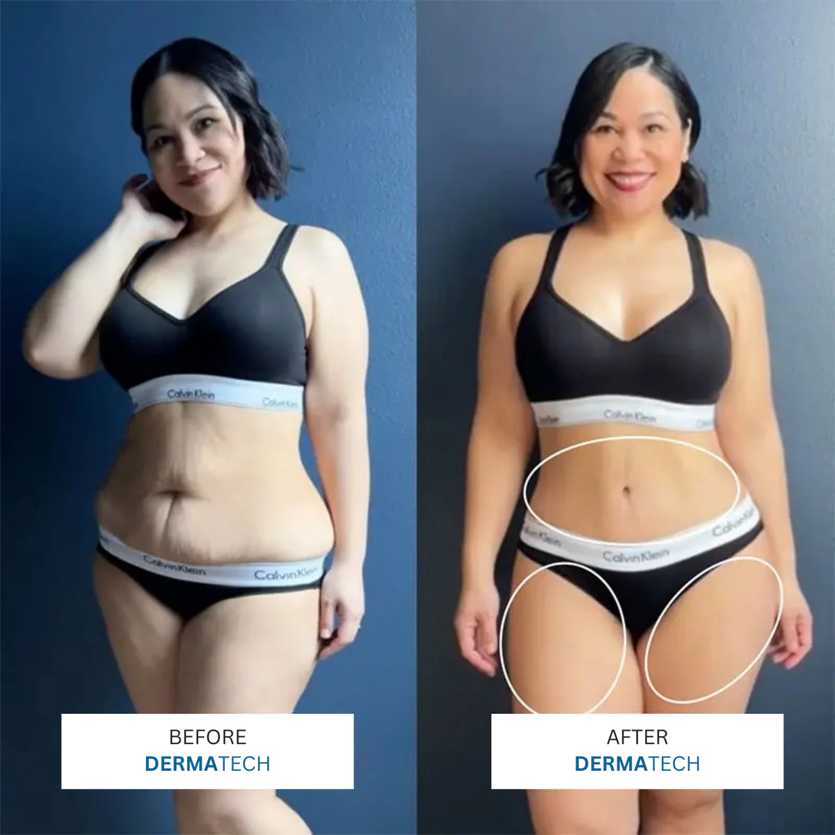 DERMATECH 3 in 1 Sculping Tech